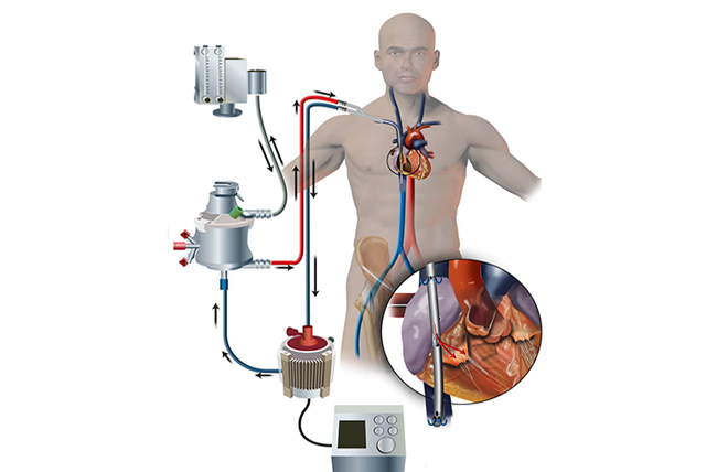 Ecmo what is An Introduction